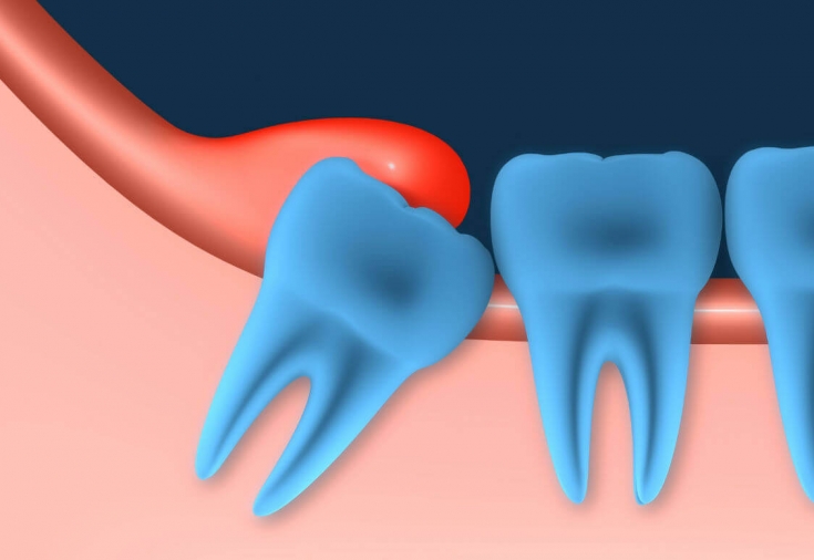 Почему болит зуб мудрости?