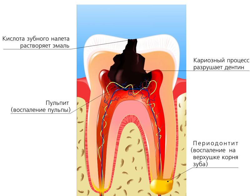 Пульпит - симптомы болезни