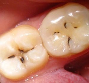 Как быстро развивается кариес зубов?