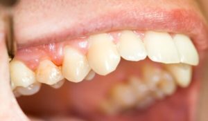 Основные признаки периодонтита зуба
