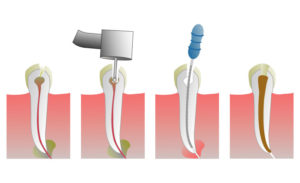 Про лечение каналов зуба
