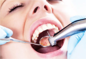Как происходит лечение каналов зуба?