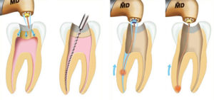 Каналы зуба и их лечение