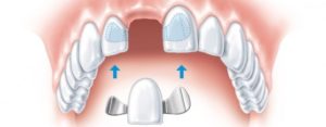 Особенности при протезировании передних зубов