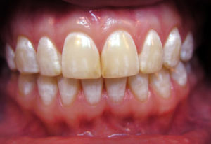 Флюороз эмали зубов