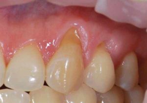 Как лечить флюороз зубов?