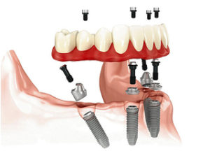 Особенности протезирования зубов на имплантах