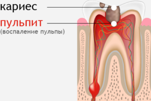 Профилактика пульпита в стоматологии