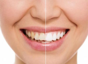 Реставрация зубов фотополимерными материалами