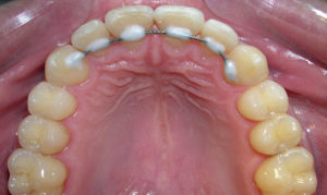 Показания и противопоказания при шинировании зубов