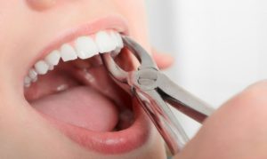 Как происходит удаление зуба мудрости?
