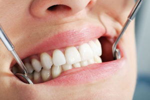 Уход за зубами после протезирования зубов