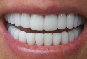 Этапы эстетической реставрации зубов