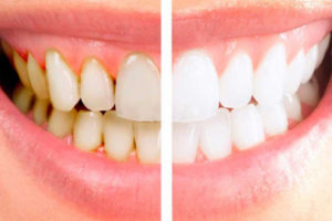 Этапы проведения профессиональной чистки зубов