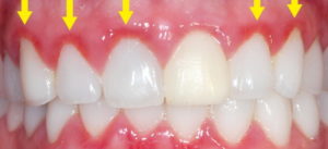Гингивит в стоматологии