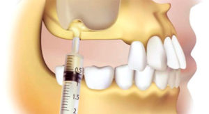 Осложнения во время имплантации зубов