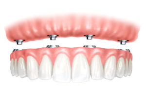 Имплантация зубов - альтернатива протезированию