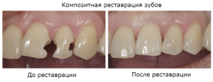 Наращивание зубов композитом