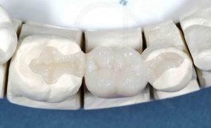Процесс микропротезирования зубов
