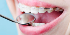 Про виды брекетов в стоматологии