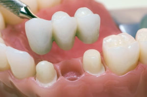 Особенности зубного протезирования зубов