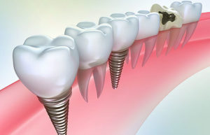 Новейшее протезирование зубов