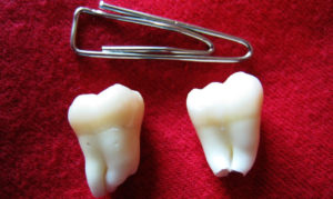 В каких случаях следует удалять зубы мудрости?