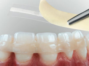 Какие виды шинирования зубов?
