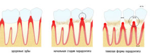 Хроническая стадия периодонтита