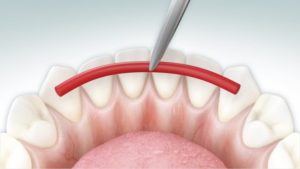 Шинирование зубов в стоматологии