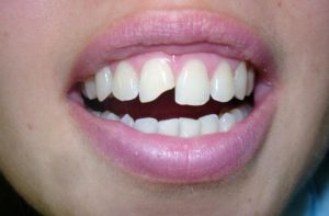 Реставрация искривленных зубов
