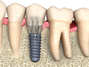 Поздняя имплантация зубов