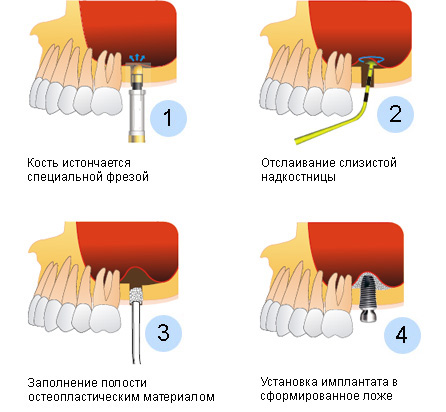 Что такое синус-лифтинг в стоматологии?