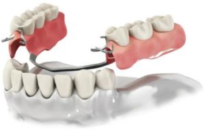 Плюсы и минусы несъемного протезирования зубов