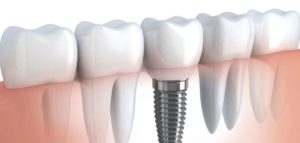 Все основные преимущества зубных имплантов