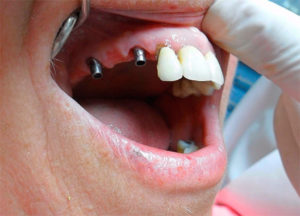 Реабилитация после имплантации зубов