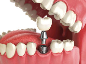 Что же такое протезирование зубов?