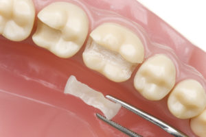 Как происходит изготовление вкладки для зуба?