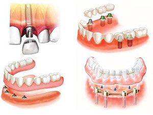 Какие виды протезирования зубов лучше?