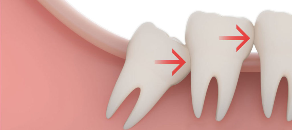 Показания для устранения зуба мудрости