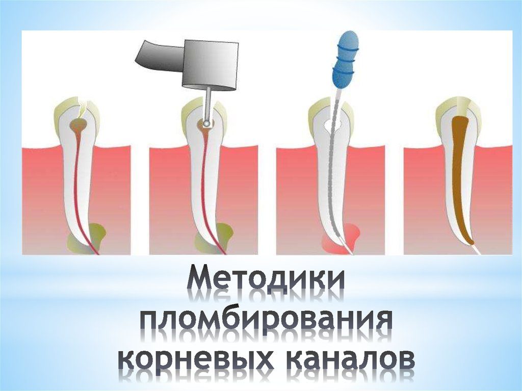 Методики пломбирования каналов