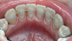 Способы и виды шинирования зубов