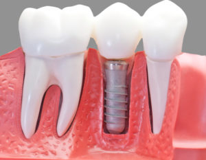 Что такое имплантация зубов под ключ?