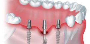Технология щадящей имплантации зубов
