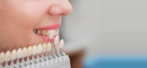 Этапы подготовки к протезированию зубов